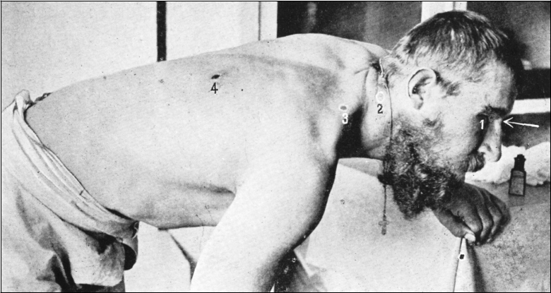 Множественные сквозные ранения оболочечной пулей, 1915 г. (из журнала «Вестник офтальмологии», т. XXXIII, 1916 г.) 